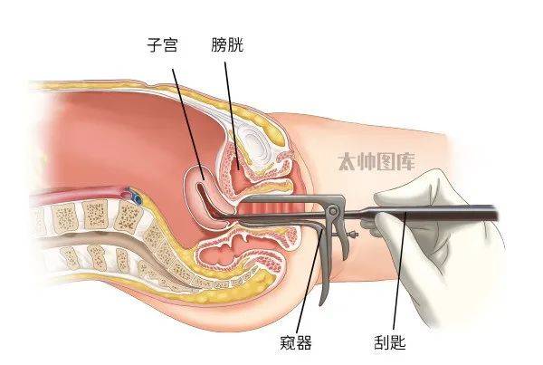 妇科手术之诊刮