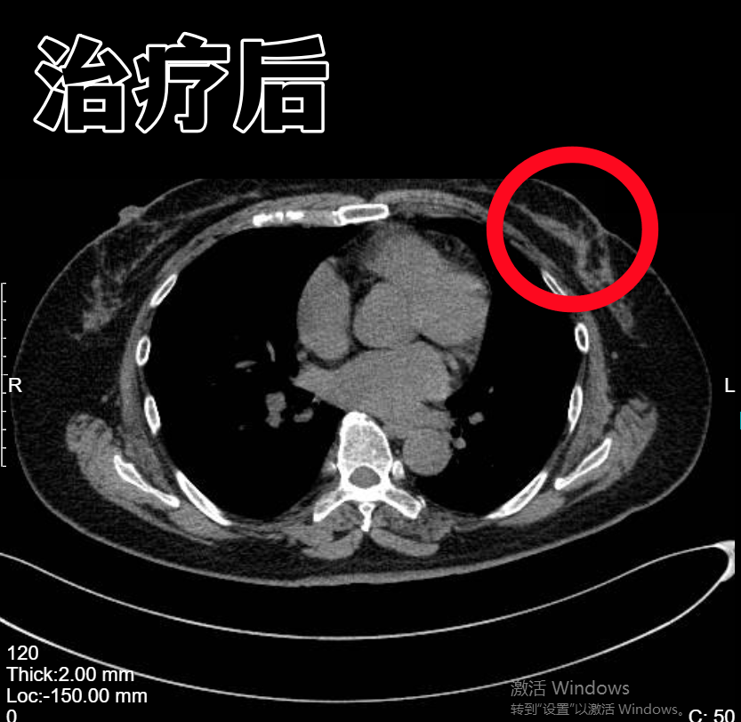 病例分享 ▏乳腺恶性肿瘤 如今肿瘤消失指标一切正常(图3)