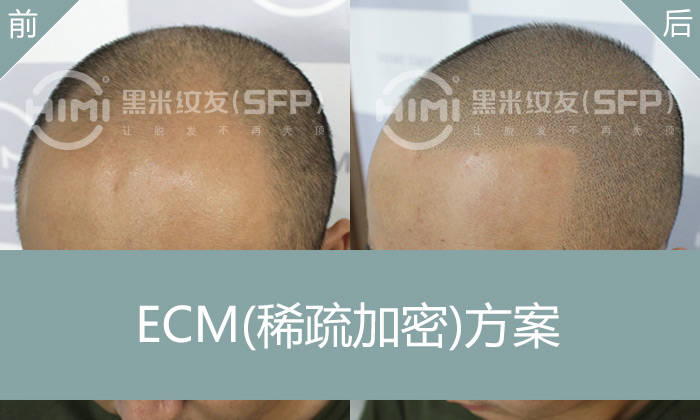 发际线后移能不能纹发？发际线后移的逆袭之路