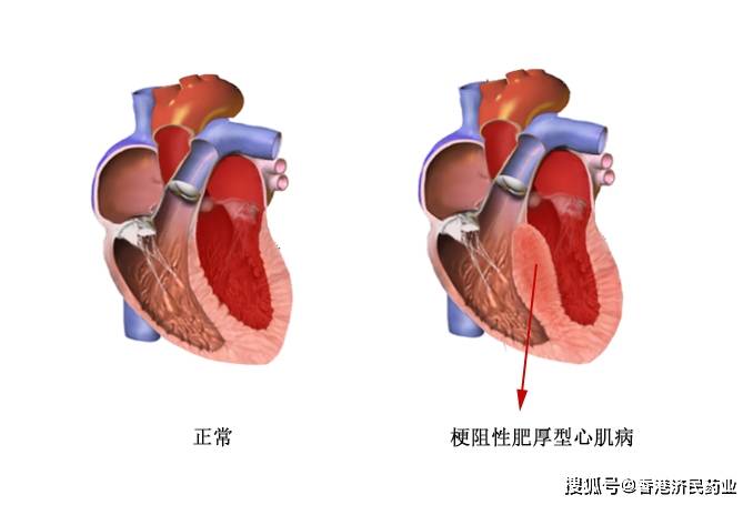 长期扩展研究3.5年随访：CAMZYOS持续改善梗阻性肥厚型心肌病(图1)