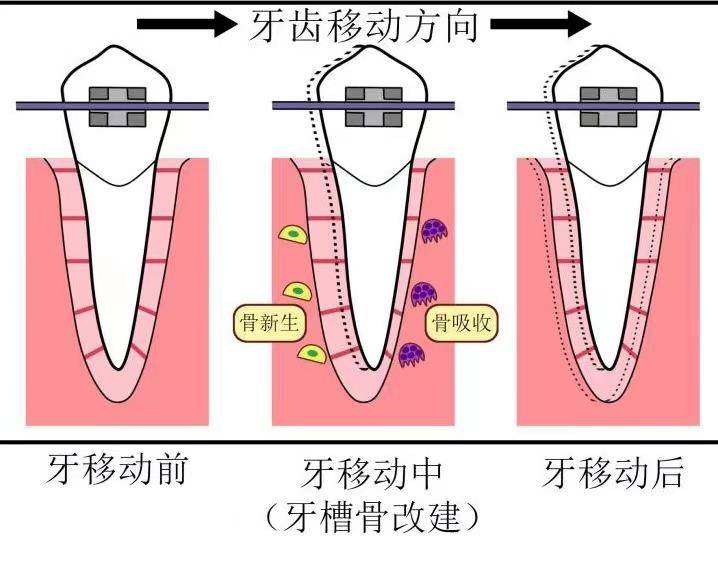 邢台正畸专家：牙齿矫正会导致人老之后牙齿过早脱落吗？(图2)