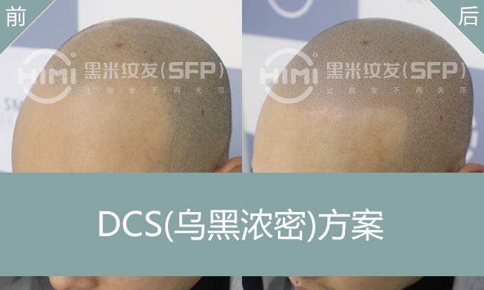 发际线后移能纹发吗？重现失去的发际线，找回自信
