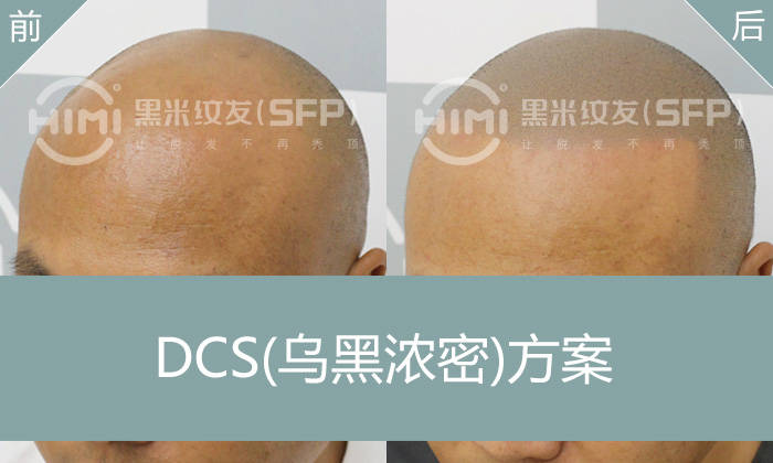 秃顶要做纹发，让秃顶变帅气寸头