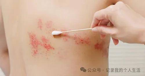带状疱疹（生蛇）原因及症状