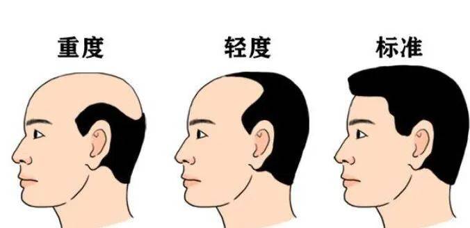 长沙皮肤科医院曝光：发际线后移怎么恢复？