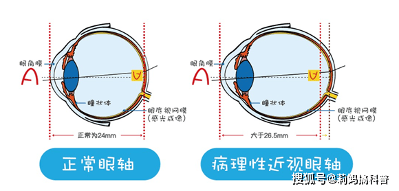 封康教授：什么是病理性近视，该如何治疗？