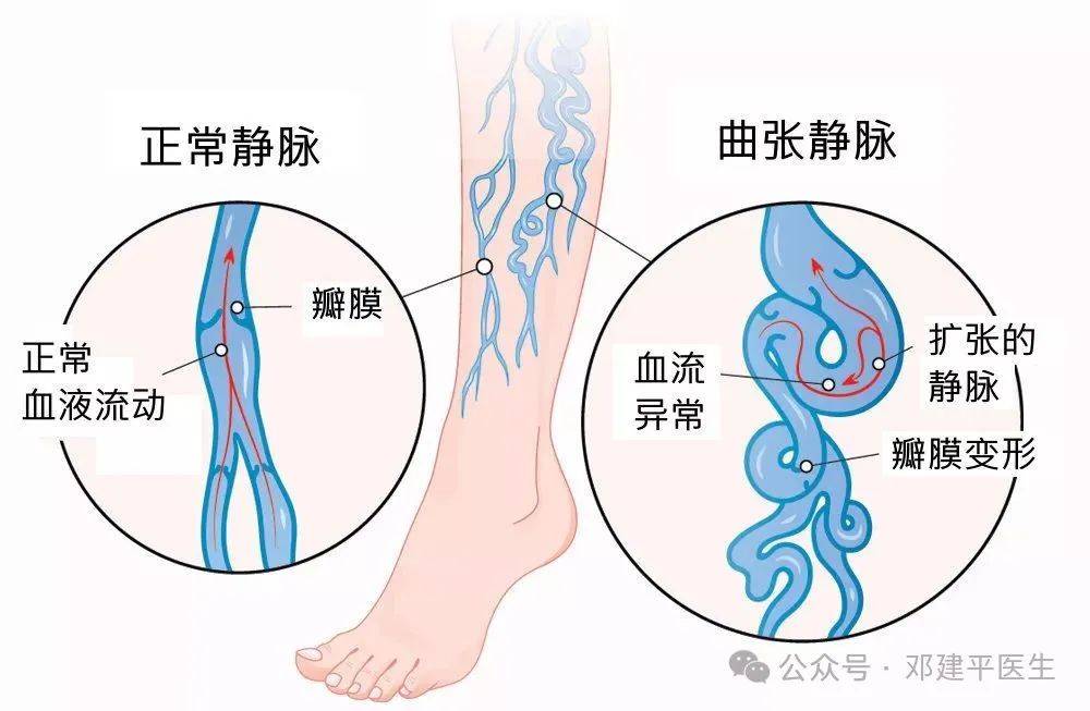 广东哪里治疗静脉曲张：静脉曲张能痊愈吗？