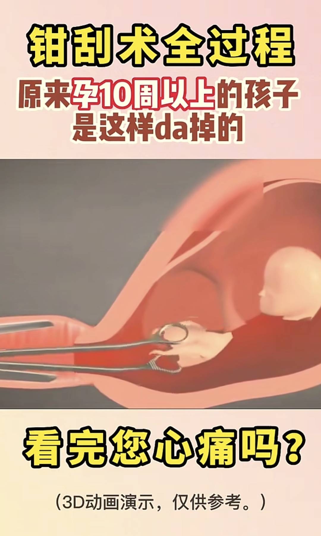 怀孕超过这孕周医生不让流产!大月龄引产3D图让人惊呼:残忍