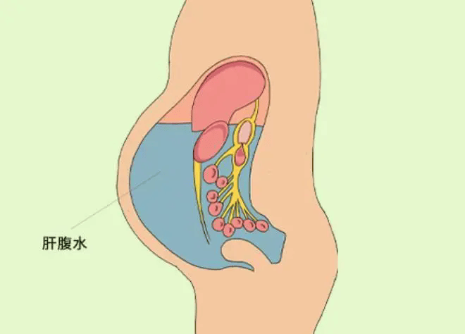 武汉仁康中医庞世琼专家揭秘，肝硬化形成腹水的6大原由