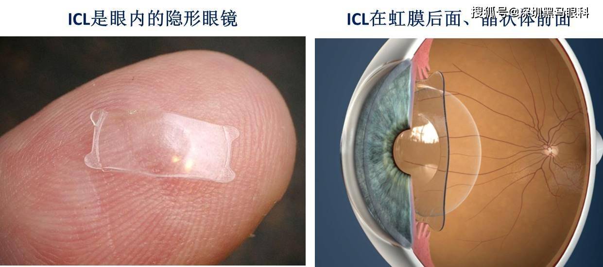 屈光手术近代发展历程