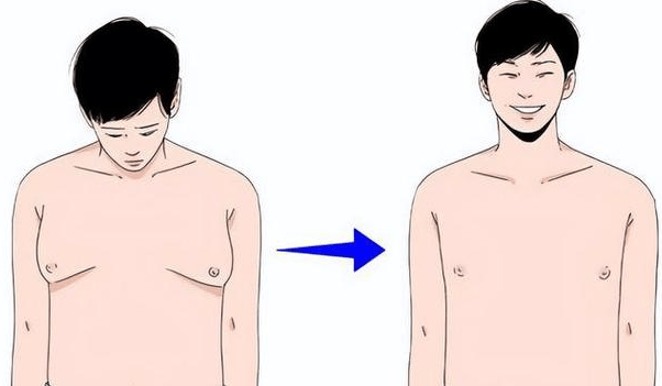 正确看待男性乳腺发育问题(图1)