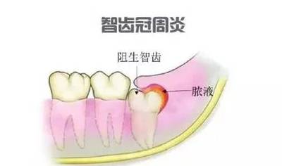 不容忽视的口腔问题：智齿冠周炎 | 郑州市口腔医院 张睿(图1)