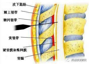 长期慢性腰背痛的常见原因：棘上韧带炎
