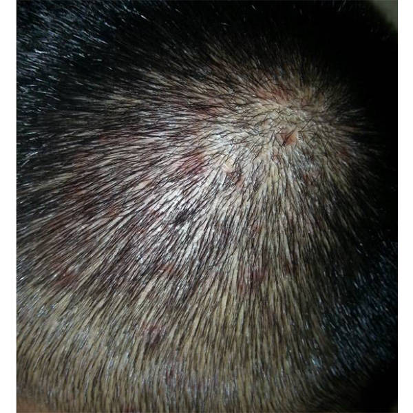 头皮问题产生的原因：头皮屑、头痒和毛囊炎可以有多种原因，通常涉及头