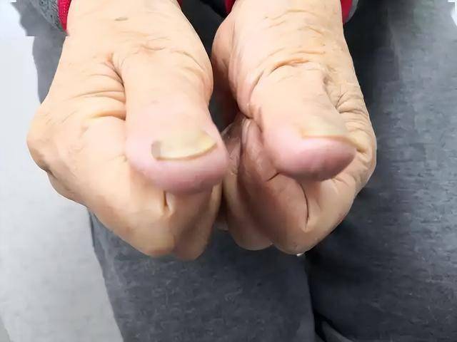 杵状指”，就是指尖末端变粗，指甲变弯变厚，这在肺癌患者中比较常见。