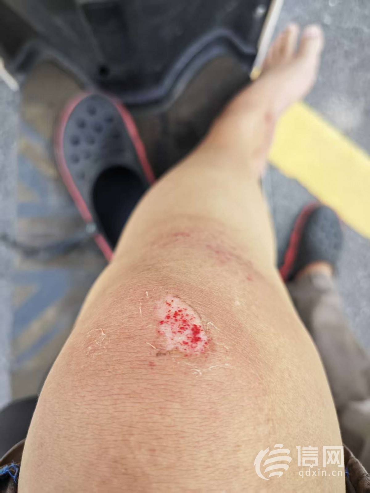 百色一男子避让法院警车摔骨折：警车未亮警灯跨双黄线、责任认定待查