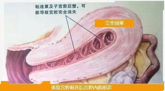 宫腔粘连：从“把粘连分开”到“帮子宫真正修复”