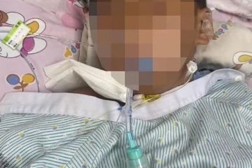 3岁男童扁桃体手术后脑死亡：医院称手术监控已被覆盖看不了
