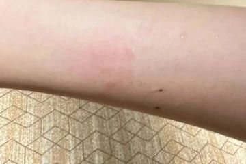 女子称入住全季酒店半夜被老鼠咬醒：酒店提出赔