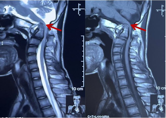 術前頸椎ct及3d打印模型:樞椎向上向後移位明顯,致椎管異常狹窄