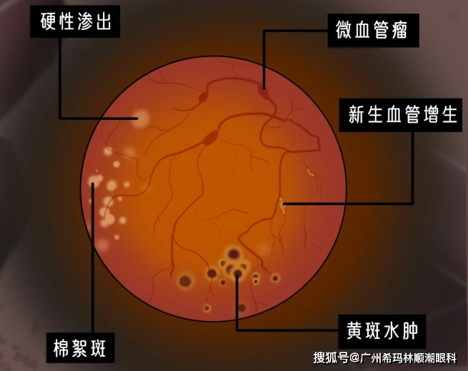 tvb老戲骨自曝單眼失明,和糖尿病有關._血管__盧