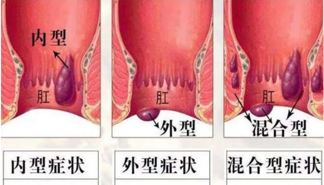 痔疮怎么会出现在我身上呢?_工作_静脉_生活