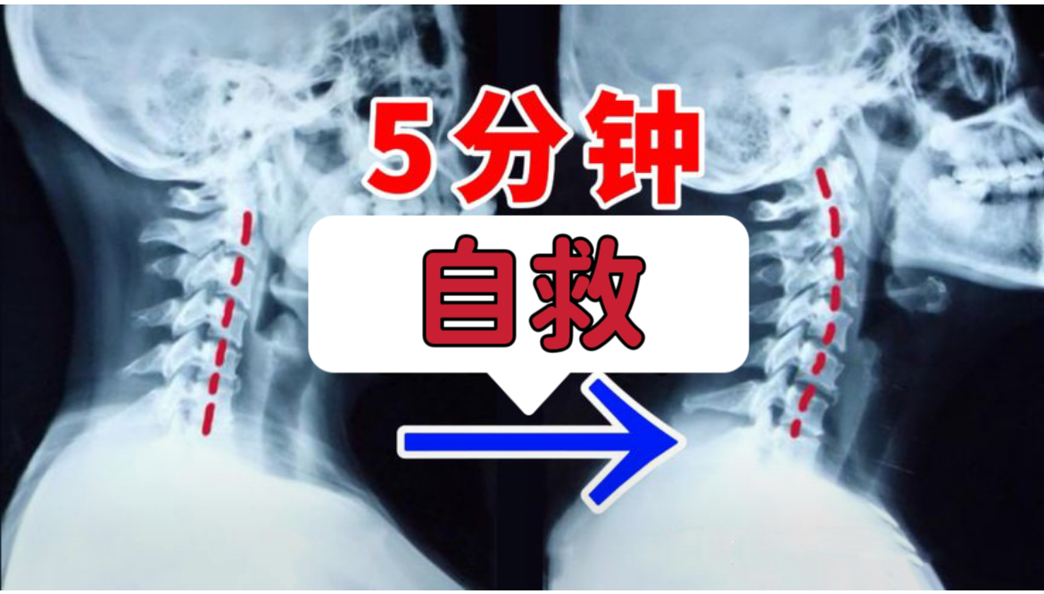 頸椎病反覆疼痛?過來人一個方法,每天幾分鐘頭暈手麻全好了!