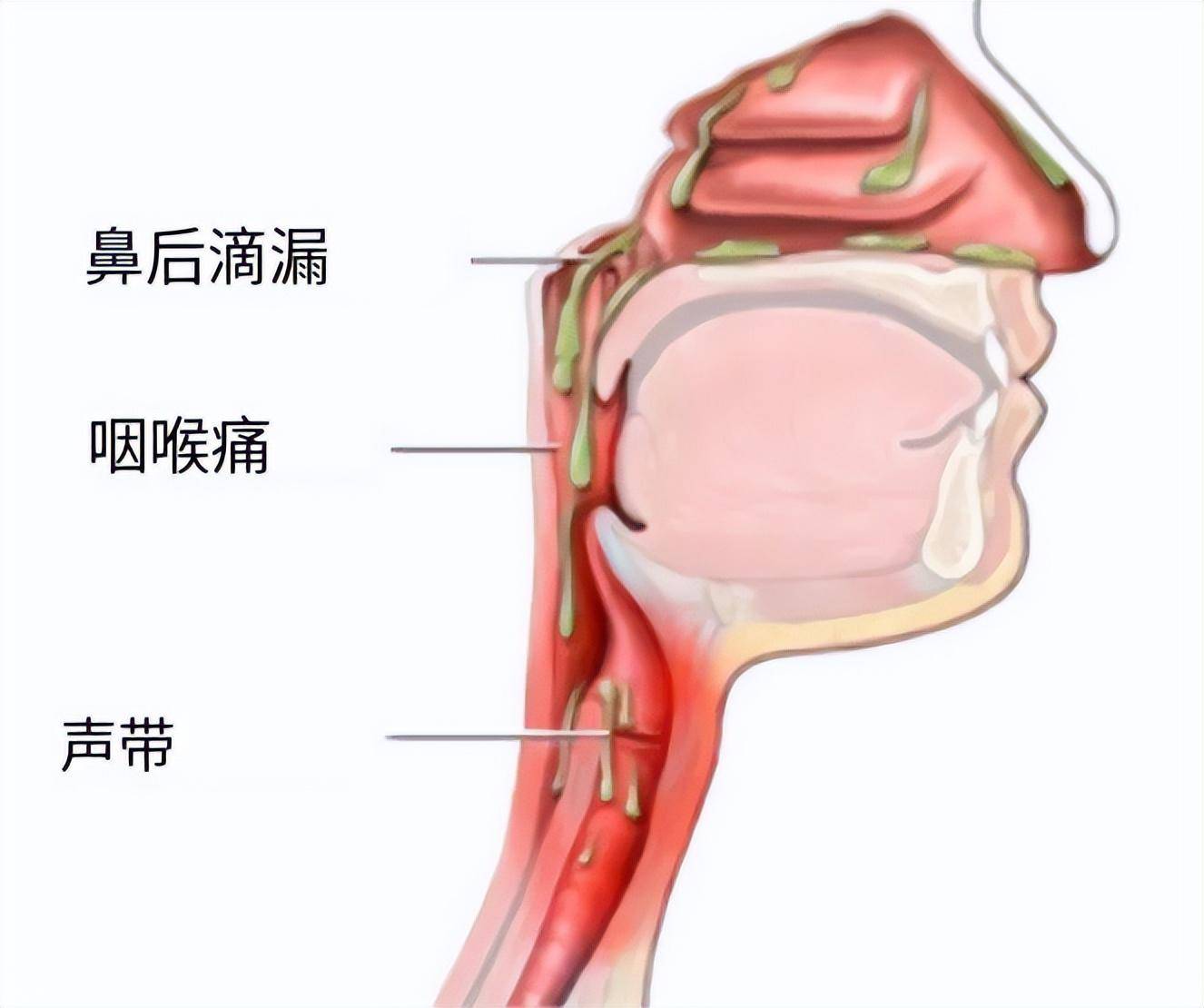 鼻后滴漏综合征是什么有哪些症状(附原因、治疗方式是什么及如何预防)