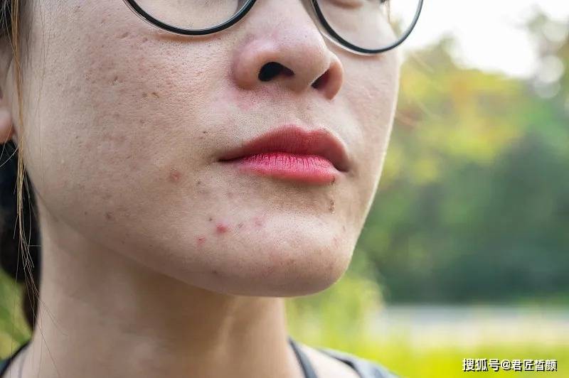 下巴反复长痘痘是什么原因 下巴长痘是胃火还是肝火_问题_饮食_调整