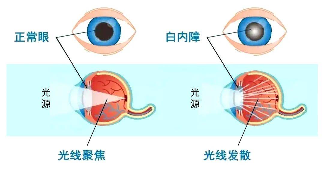 白內障手術是目前治療白內障最有效的方法之一.