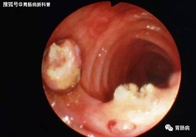 24岁肠癌晚期——医生提醒:一旦有这些"不舒服",赶紧去做肠镜!