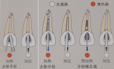 根管中的"冷牙胶"和"热牙胶"是什么?你能分清吗?