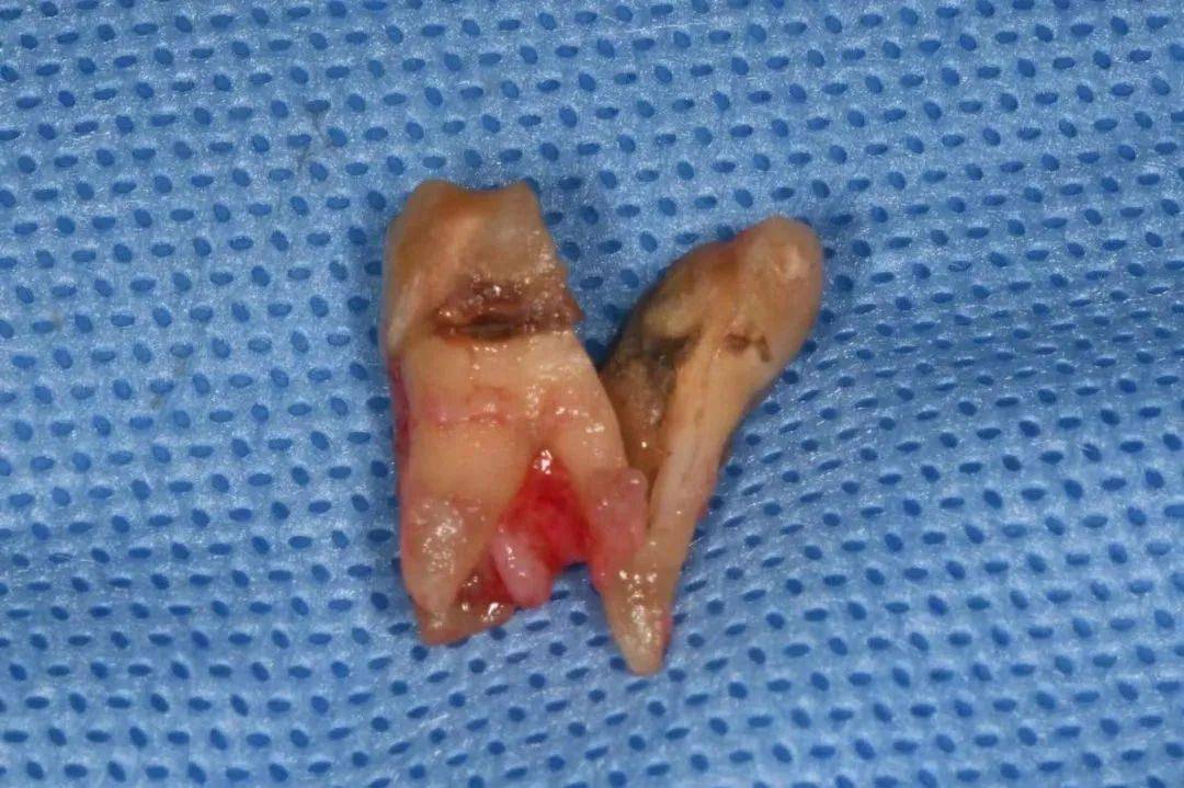 牙隐裂是指牙冠表面的非生理性细小裂纹,常不易被发现