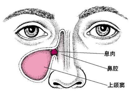鼻粘膜肿胀如何消肿图片