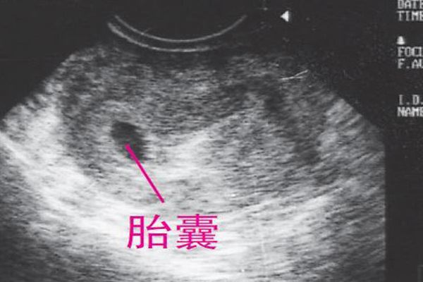 两个月胎儿b超照片图片