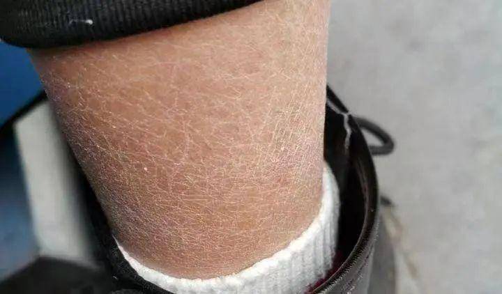 静电在人体周围可以产生大量的阳离子,使皮肤水分减少,进而使皮屑增多