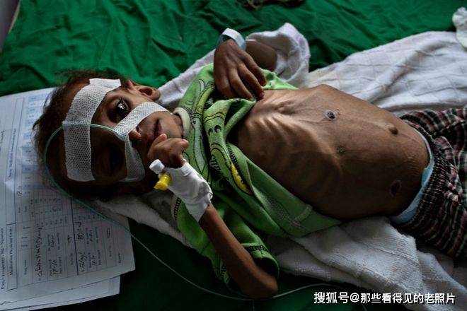 也门内战的受害者 7岁小女孩因严重营养不良死亡_amal_hussain_照片