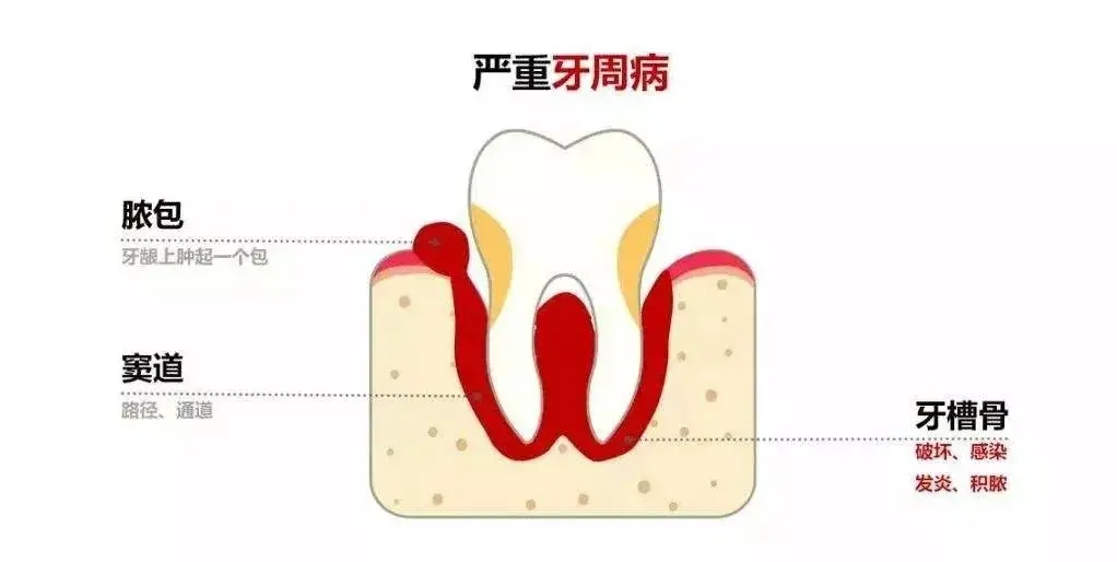 我们来看看哪些原因会造成牙槽骨骨质增生:慢性局部炎症刺激,譬如慢性