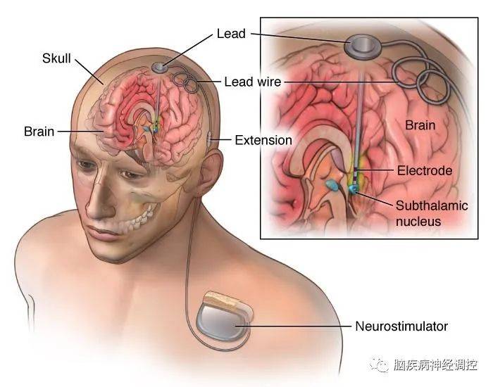 藥物治療種類和方案的可選性比較多,臨床上比較常用的是美多芭,森福羅