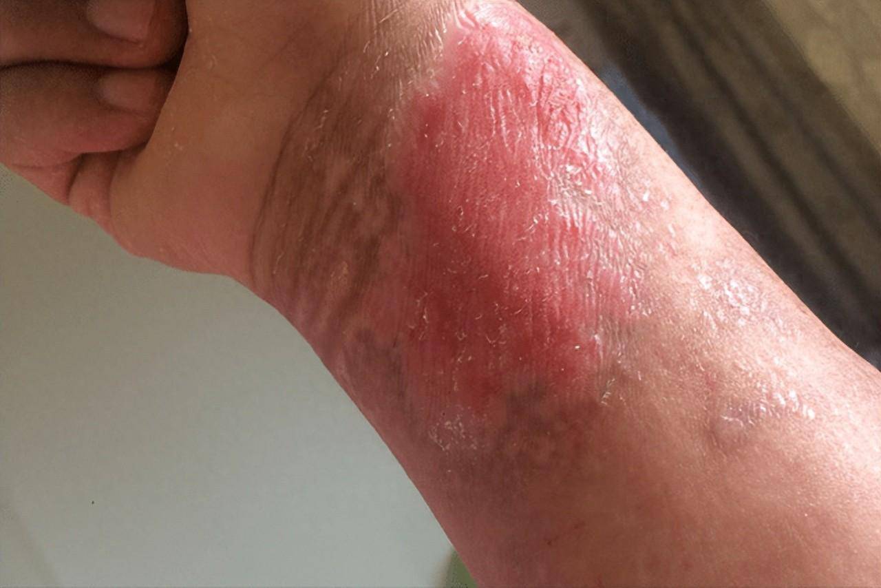 跟着我做,45天疤痕消失,皮肤无痕不增生!_效果_方法_losis