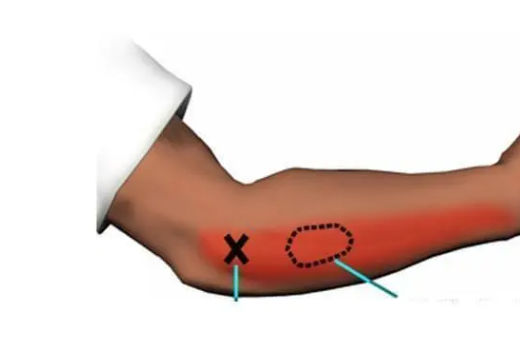 治疗网球肘最好的方法是什么?为什么?