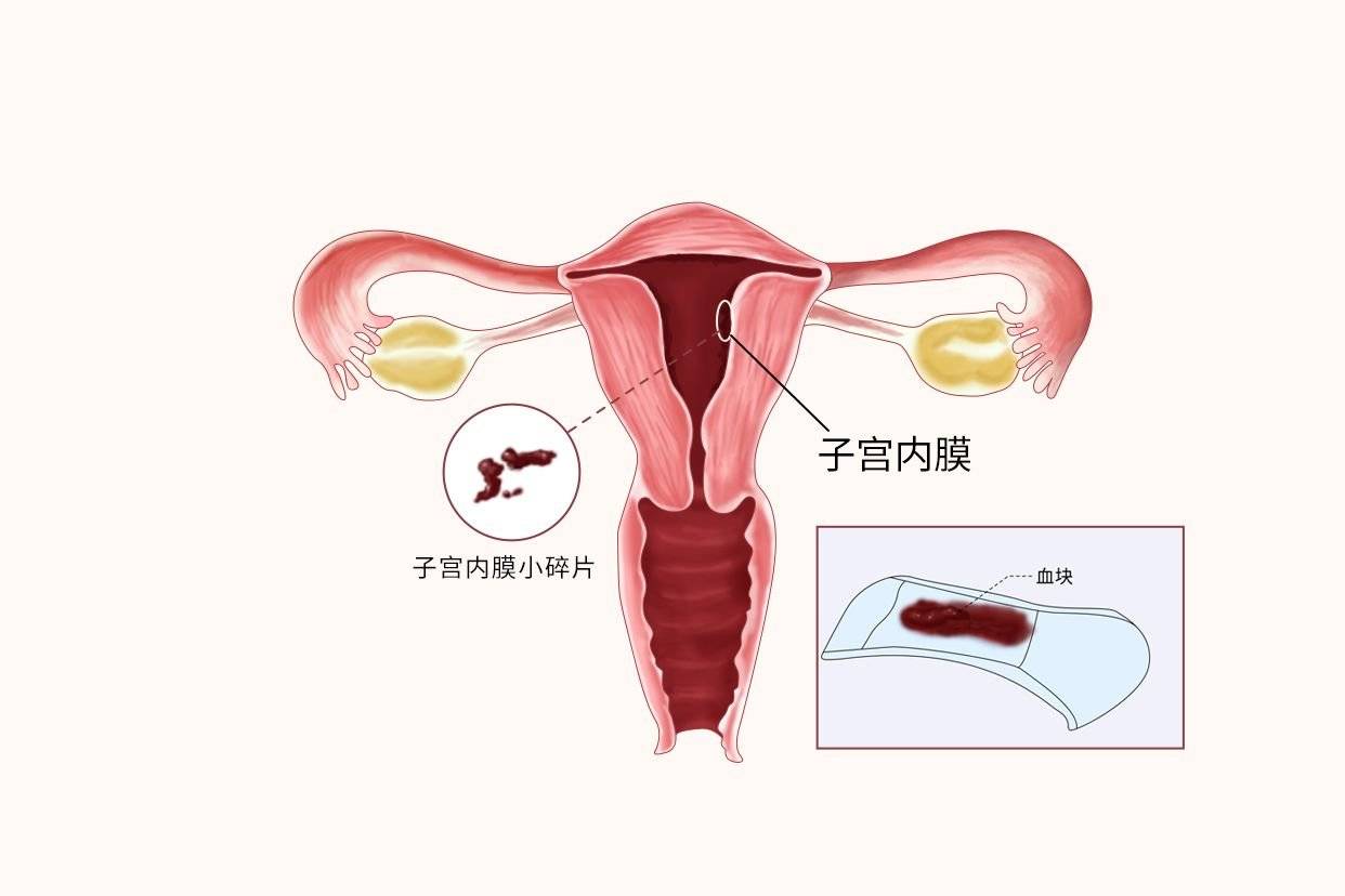 子宫内膜息肉?预防方法及原因来咯!