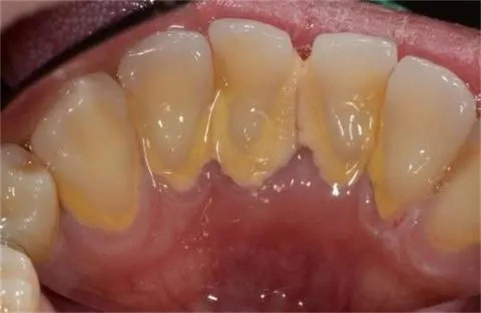 牙粉_牙齿_口气