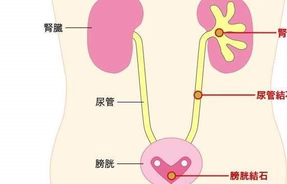 相對應的泌尿系統結石就是:膀胱結石,腎結石,尿結石,和輸尿管結石.