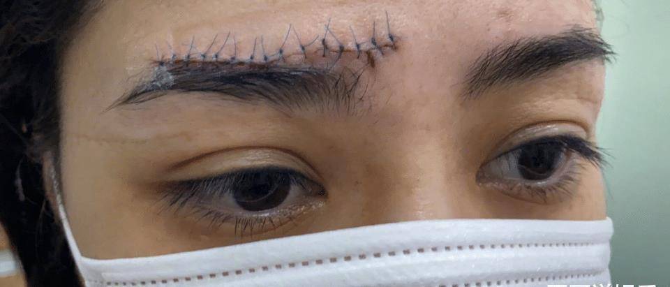 眉毛缝针弯弯曲曲像蜈蚣,网友:可以算毁容了!_照片_状态_伤害