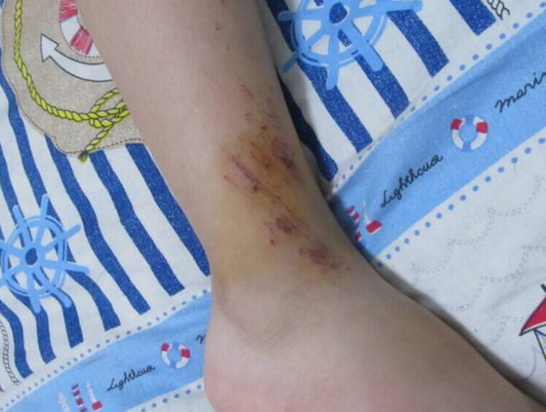 看着孩子脚上的伤,我说了三个字,孩子在学校再没被欺负_儿子_时候