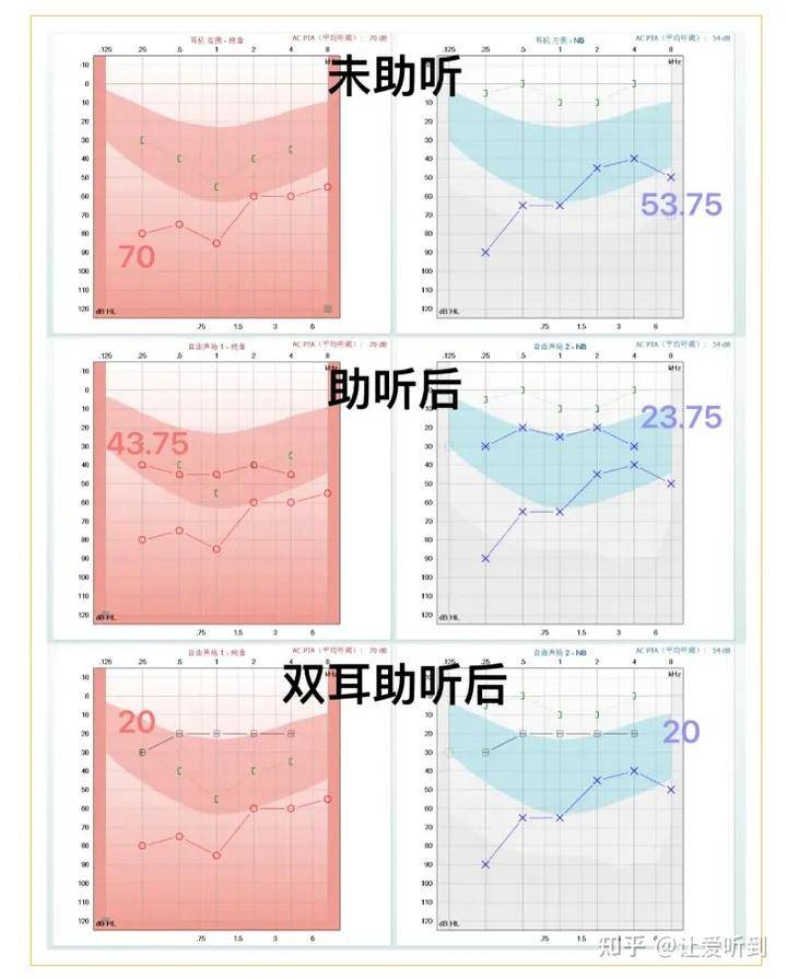 昊昊完善言語評估測試,助聽前後相差95%,可見昊昊戴上助聽器後言語