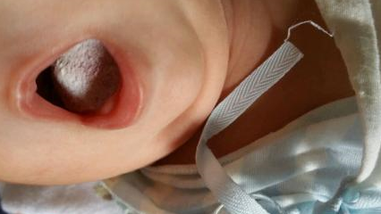 婴儿口腔两侧发白图片图片