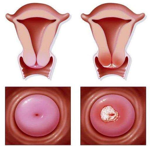 宫颈炎会变成宫颈癌吗图片