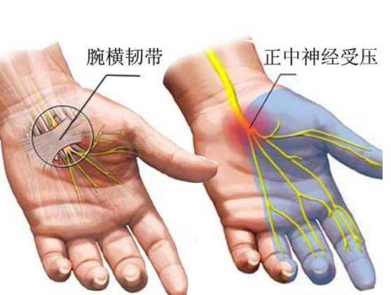这是一种影响手和脚的觉得和运动神经的疾病,可能招致手和脚部麻木